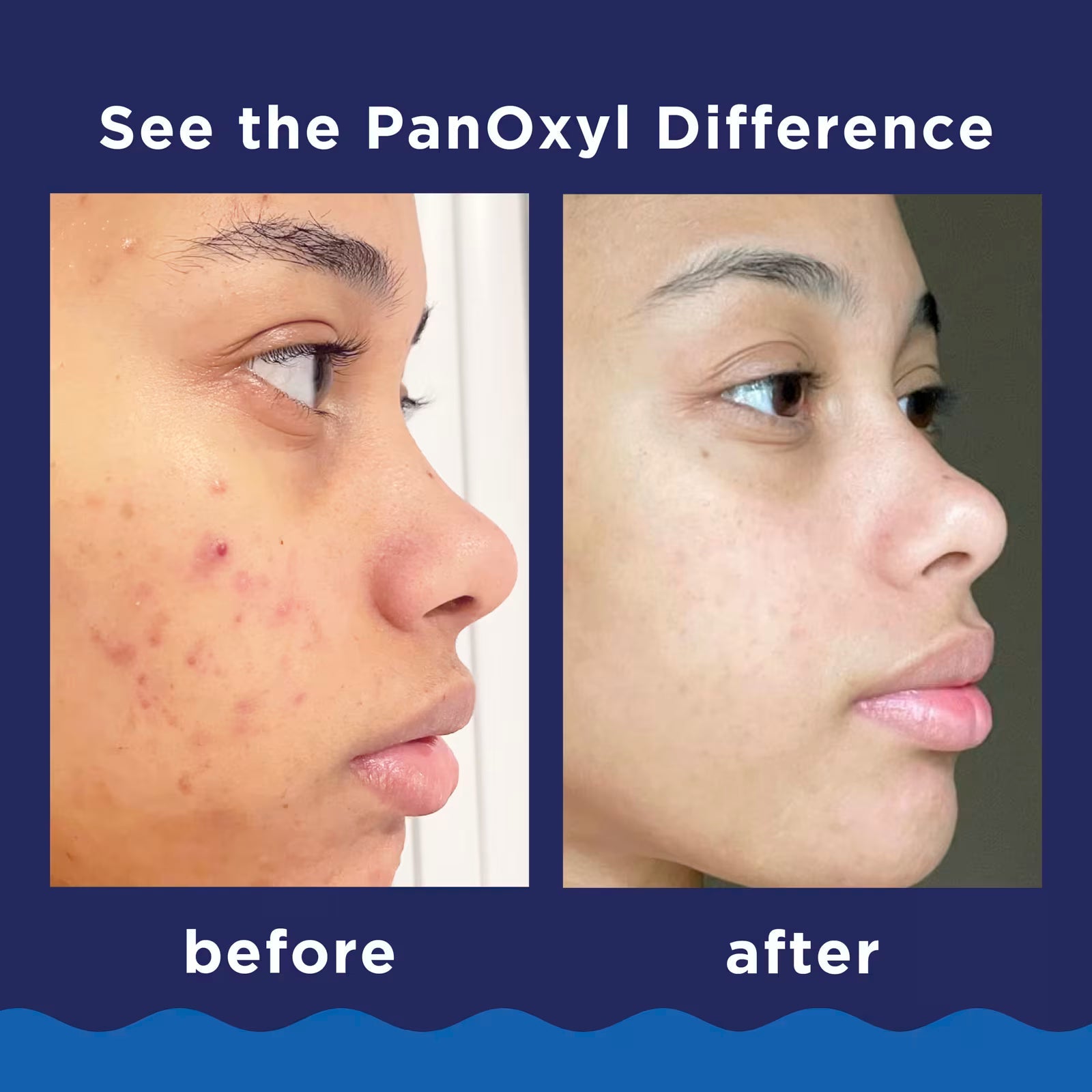 PanOxyl Benzoyl Peroxide Acne Foaming Wash (28g)